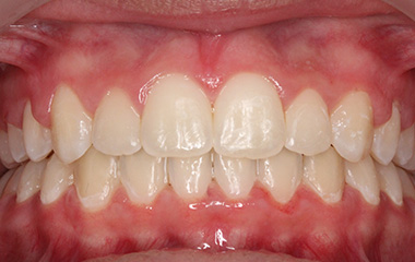 Avery - After Braces Results | Jordan Orthodontics