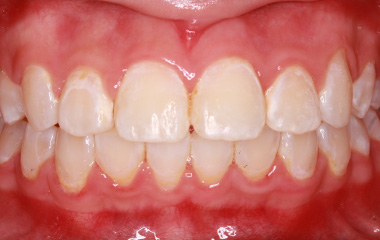 Holly - After Braces Results | Jordan Orthodontics