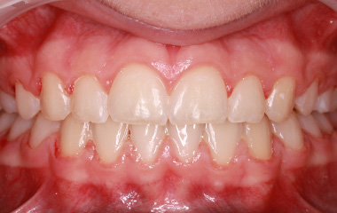 Penina - After Braces Results | Jordan Orthodontics