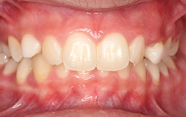 Avery - Before Braces Results | Jordan Orthodontics
