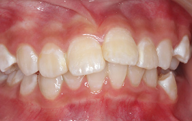 Holly - Before Braces Results | Jordan Orthodontics