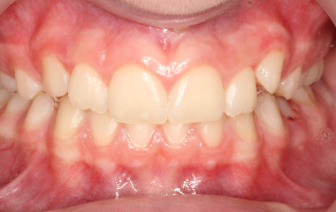 Penina - Before Braces Results | Jordan Orthodontics