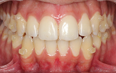 Arteen - After Invisalign Aligners Results | Jordan Orthodontics