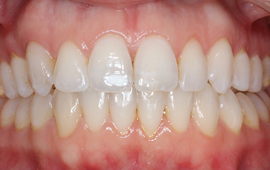 Mallory - After Invisalign Aligners Results | Jordan Orthodontics