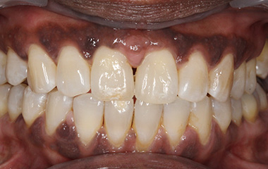 Shannon - After Invisalign Aligners Results | Jordan Orthodontics