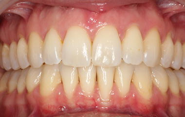 Teresa - After Invisalign Aligners Results | Jordan Orthodontics