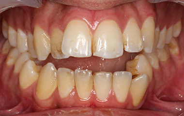 Arteen - Before Invisalign Aligners Results | Jordan Orthodontics