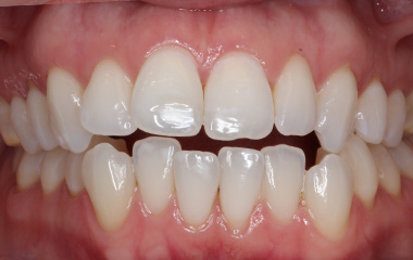 Mallory - Before Invisalign Aligners Results | Jordan Orthodontics