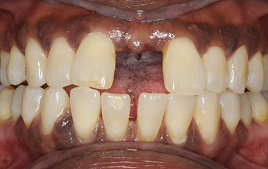 Shannon - Before Invisalign Aligners Results | Jordan Orthodontics
