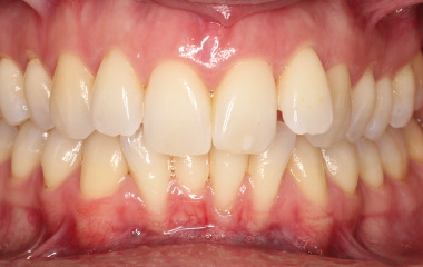 Teresa - Before Invisalign Aligners Results | Jordan Orthodontics