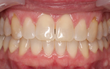 Clarendon - After Smile Express At Home Aligners | Jordan Orthodontics