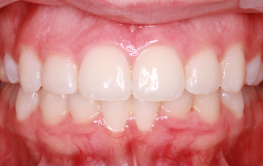 Densmore - After Smile Express At Home Aligners | Jordan Orthodontics