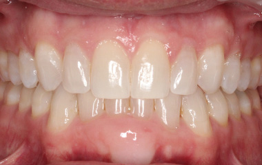 Johnson - After Smile Express At Home Aligners | Jordan Orthodontics