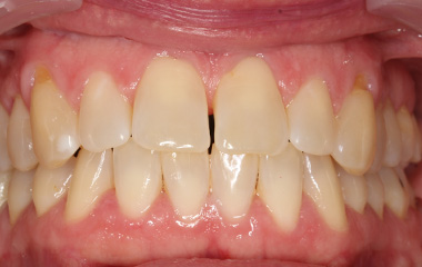 Clarendon - Before Smile Express At Home Aligners | Jordan Orthodontics
