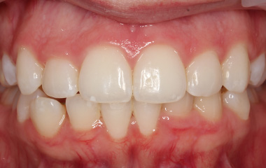 Densmore - Before Smile Express At Home Aligners | Jordan Orthodontics