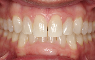 Johnson - Before Smile Express At Home Aligners | Jordan Orthodontics
